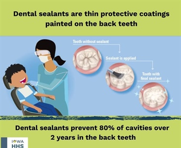 🦷 Dental Sealants: A Simple Way to Protect Smiles 🦷