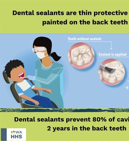 🦷 Dental Sealants: A Simple Way to Protect Smiles 🦷