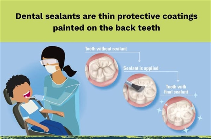 🦷 Dental Sealants: A Simple Way to Protect Smiles 🦷
